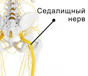 Ишиалгия — причины, симптомы, лечение