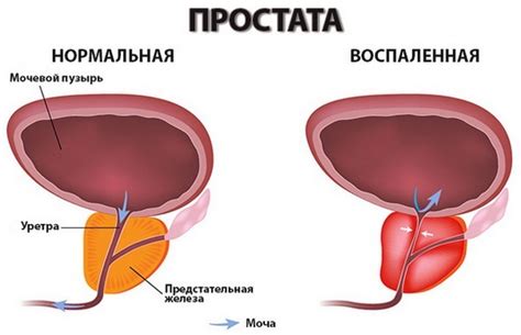 здоровье простаты