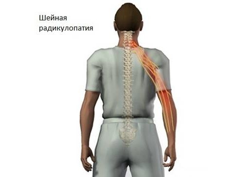 Психологические аспекты радикулопатии