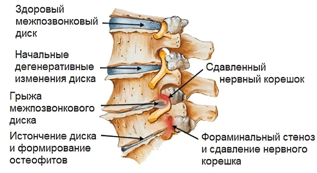 Психологические аспекты радикулопатии