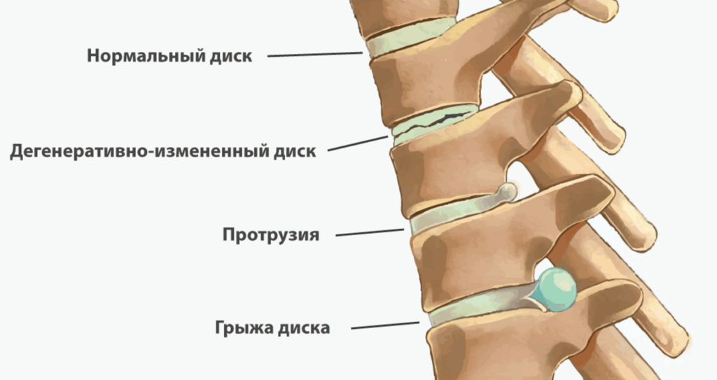 грижа хребта