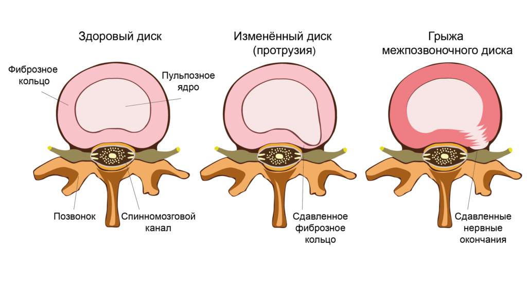 грыжа позвоночника