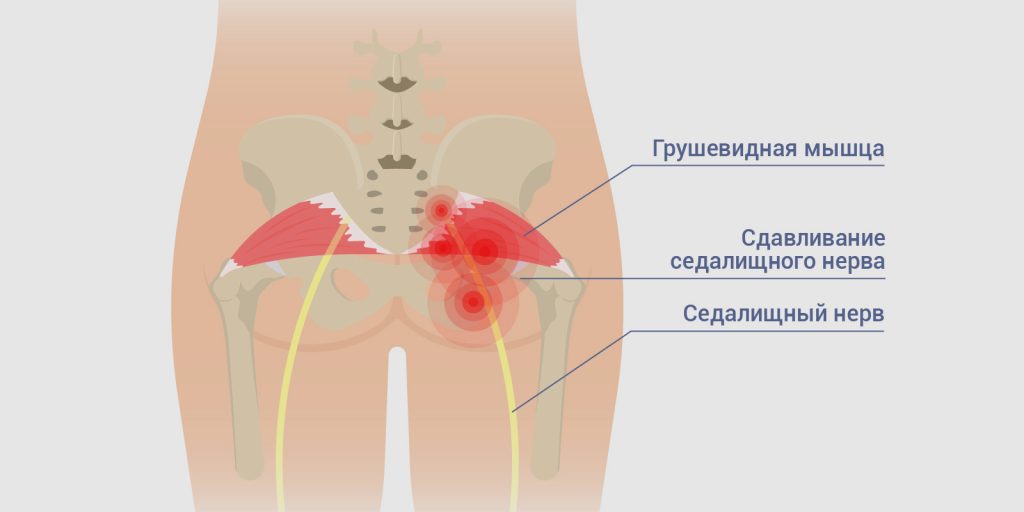 Біль сідничного нерва після операції