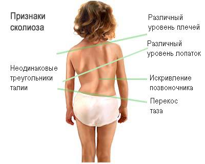 Сколиоз 2 степени