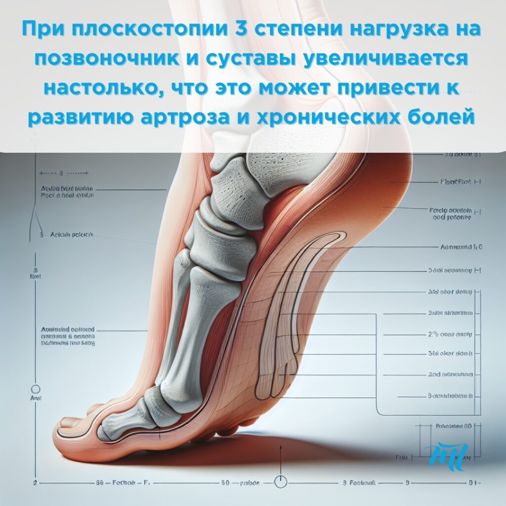 Плоскостопие 3 степени
