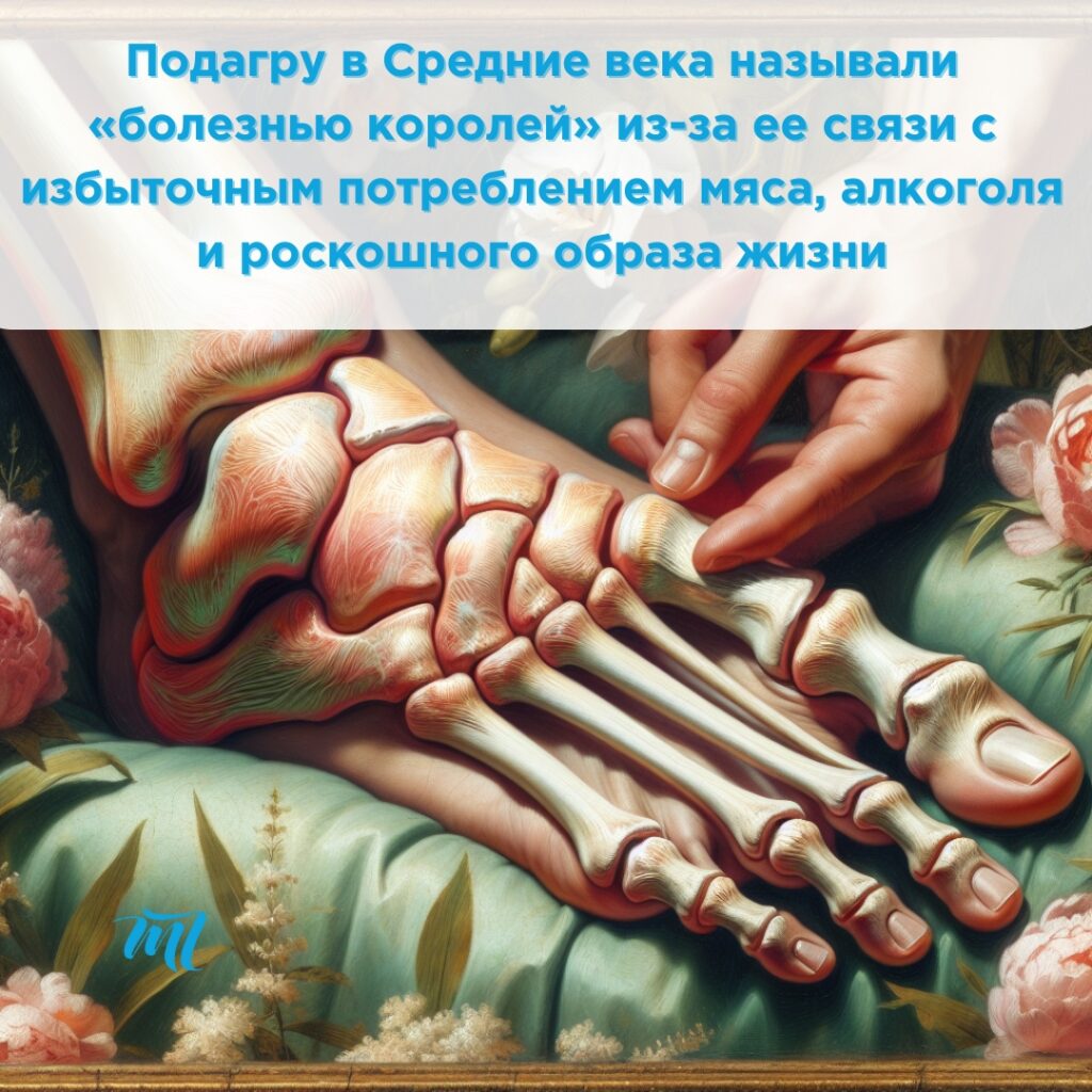 подагра