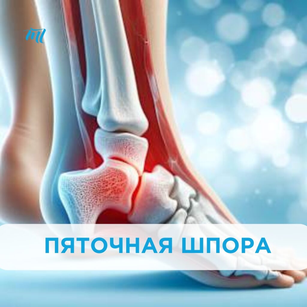 Ефективне лікування шпори: сучасні методи та підходи