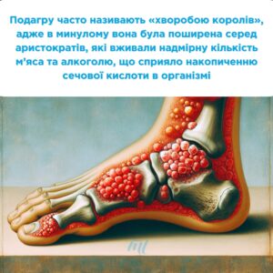 Подагра