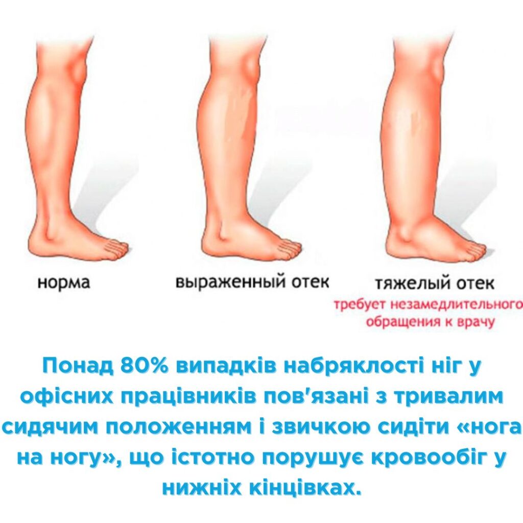 причини набряків ніг