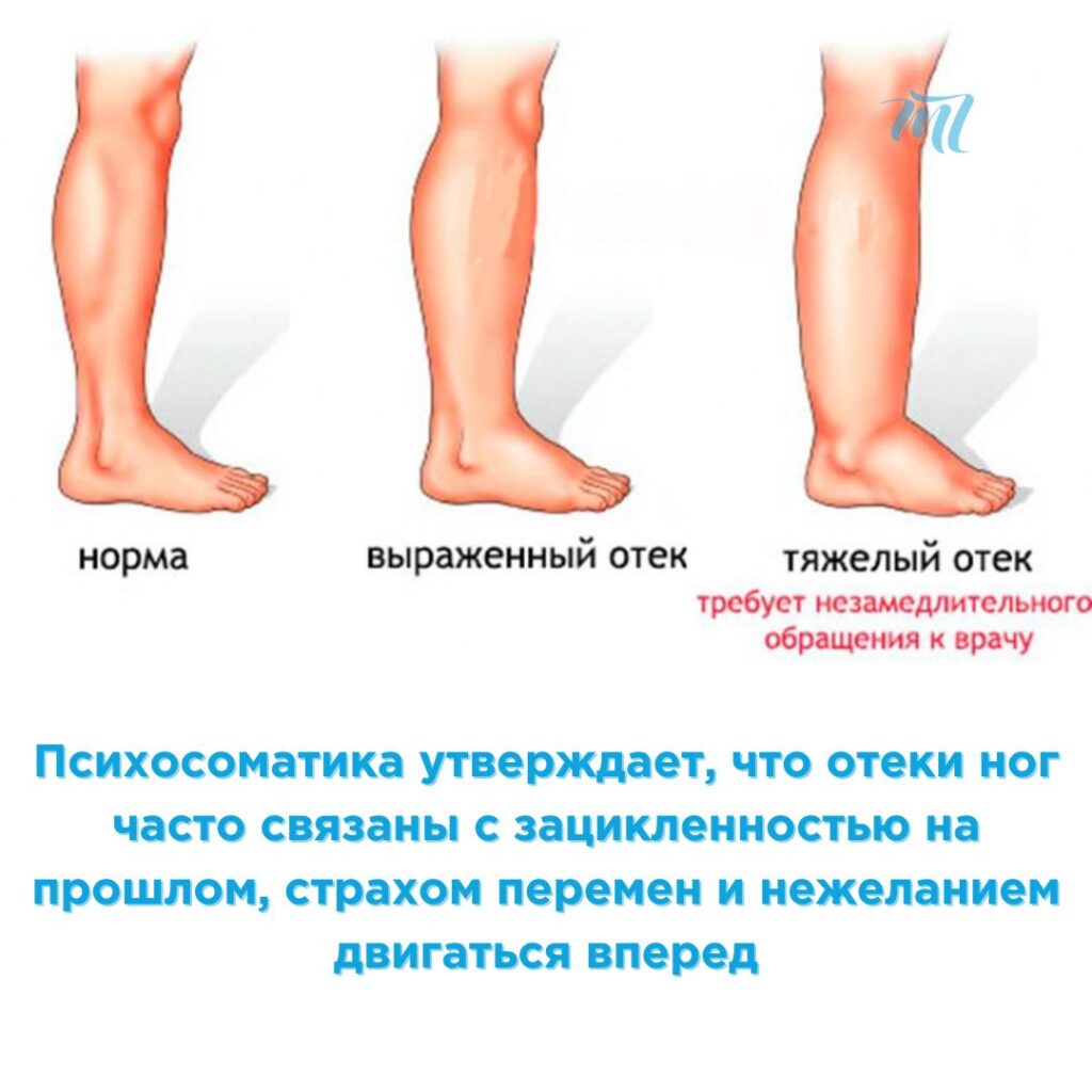 Психосоматика отеков