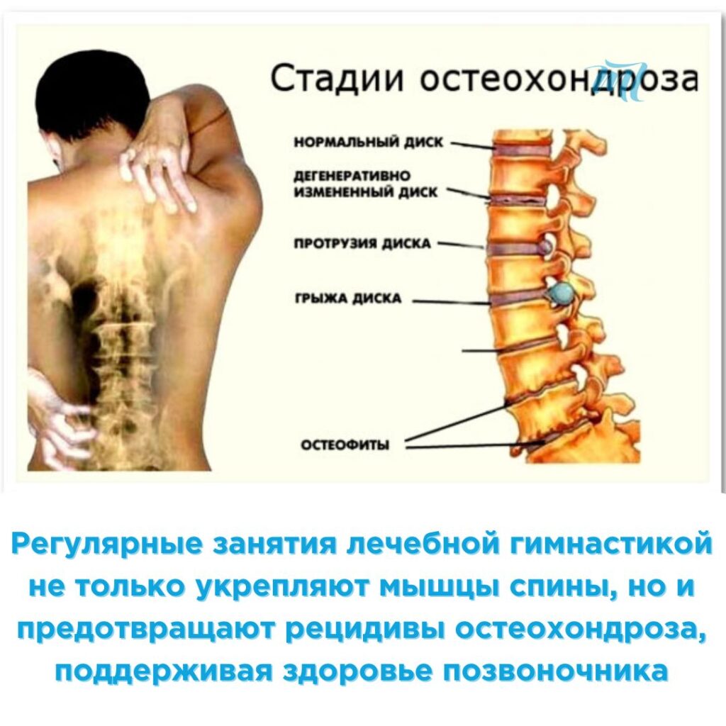 лечение остеохондроза